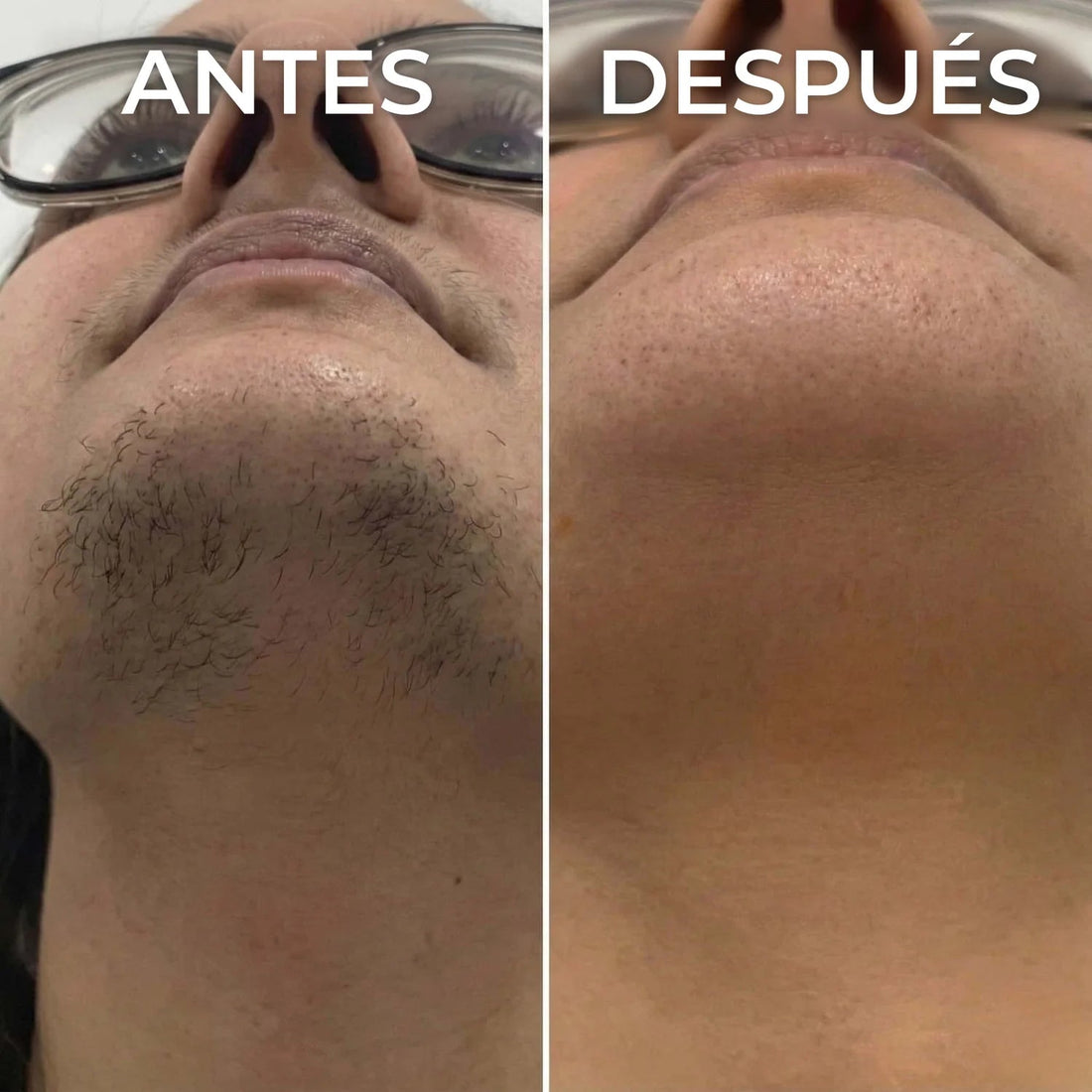 Inhibidor vegetal del vello Nesolia