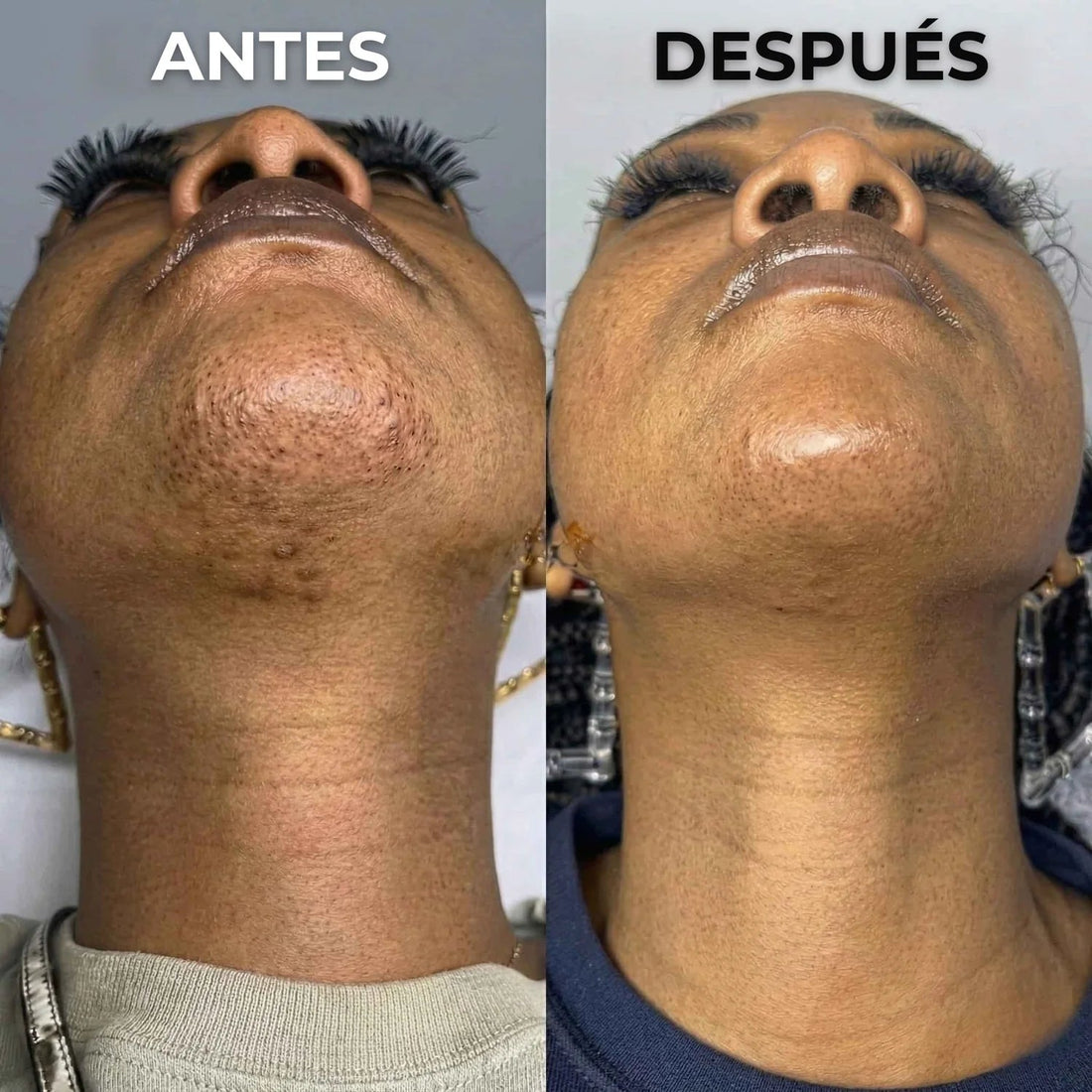 Inhibidor vegetal del vello Nesolia