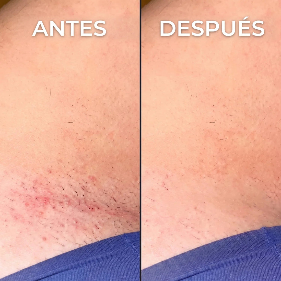 Inhibidor vegetal del vello Nesolia