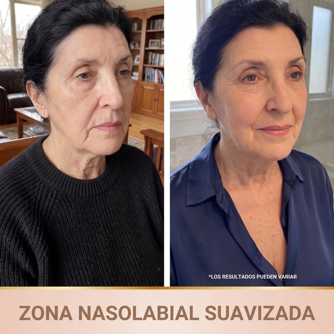 Antes y después surcos nasogenianos